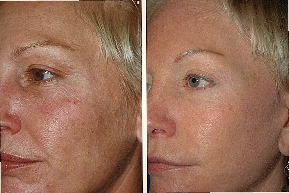 AntiAging SkinCare Kit for Older Skin-Cleanser, Serum, Peel, Toner, Moisturizer